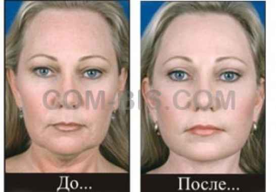 Лазерное омоложение