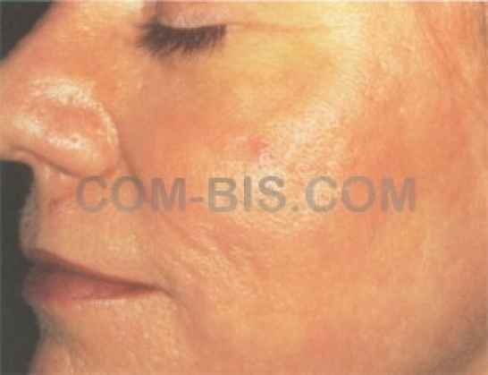 Лазерная подтяжка кожи (лифтинг)